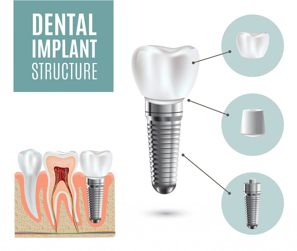 Dental Implants Lynn Travis, DDS